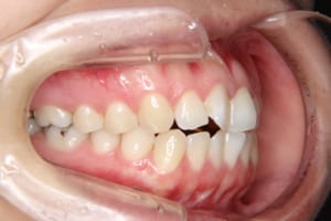前歯部の叢生、開咬が見られます。